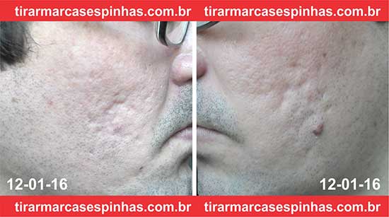 Microagulhamento para Cicatrizes de acne 2 Sessão